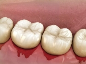 牙周病醫好會翻發嗎？羅湖牙周治療排名高嘅牙科2026？