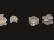 蛀牙用嵌體補牙有咩優點同缺點？大陸假牙幾錢？