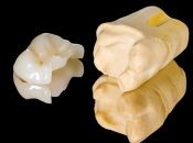 蛀牙補牙醫生點解要我做嵌體？嵌體補牙有咩好處？深圳牙科邊間好？