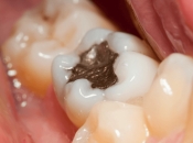 補牙後點解仲會牙痛？係咪深圳牙醫技術唔掂？
