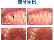 深圳種牙必知真相！維港口腔提醒：避開黑心診所陷阱