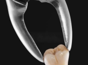 脫牙之後傷口要幾耐可以恢復好咧？福田拔牙幾錢一隻？