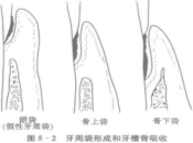 慢性牙周炎怎么治疗最有效？