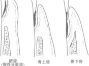 慢性牙周炎怎么治疗最有效？