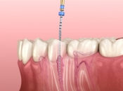 深圳杜牙根之後牙齒點解都會酸痛？係正常嘅嗎？維港口腔整牙點樣？