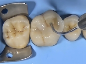 落馬洲口岸牙科維港口腔科普：蛀牙補牙後比補牙前更痛？