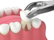 智慧齒可唔可以取代蛀壞大牙？深圳拔牙收費點樣？
