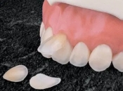 瓷牙貼片是否能夠治療變色牙？深圳牙齒貼片貴唔貴？