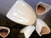 烤瓷牙顏色變色嘅原因係咩？深圳烤瓷牙會唔會容易變色？