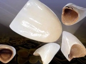 烤瓷牙顏色變色嘅原因係咩？深圳烤瓷牙會唔會容易變色？