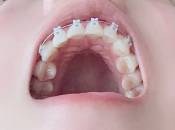 爲什麽箍牙牙齒移動咁慢？箍牙好難咩？深圳箍牙推介！