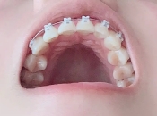 爲什麽箍牙牙齒移動咁慢？箍牙好難咩？深圳箍牙推介！