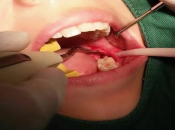 11種上深圳剝牙前需要同醫生講清楚嘅病史！