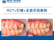 深圳維港口腔杜牙根+打樁+牙冠 平靚正體驗！