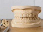 深圳牙貼面——牙貼面修復前要取模嗎？