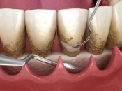 牙周刮治之後牙齒點解會變鬆？深圳牙周治療幾錢？