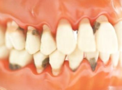 牙齦萎縮究竟係咩原因？深圳有冇得治牙齦萎縮？
