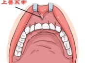 深圳牙齒美白——牙齦有問題還可以進行貼面或者瓷牙套嗎？