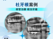 「深圳維港口腔科普」杜牙根後牙齒可以用幾耐？保牙效果關鍵睇呢幾點！