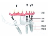 上深圳做即刻負重有咩優勢？深圳牙科邊間好？ 