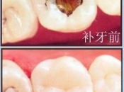 北上深圳補牙選擇哪種材料好呢？