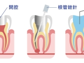 牙痛就要杜牙根嗎？維港口腔杜牙根收費標準