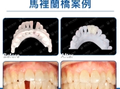 牙縫細唔適合種牙又唔想磨牙做牙橋點算咧？維港口腔好唔好？