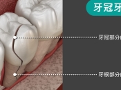 深圳種牙討論：牙裂係唔係就要剝牙植牙咧？