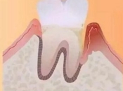 點樣治療牙齒鬆動？深圳牙周病治療邊度好？