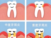 牙周病會有咩症狀咧？維港口腔輕度全口牙周治療1200/療程