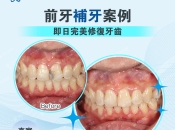 補牙痛唔痛？深圳補牙價錢？