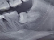 深圳拔牙科普——阻生牙是什麼呢？為什麼要小心拔除呢？