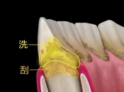 維港口腔牙周治療科普：牙周病係點樣治療嘅咧？維港口腔牙周治療幾錢？
