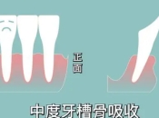 牙槽骨吸收太嚴重仲可唔可以種牙？深圳平靚正種植牙推薦