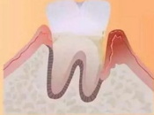 點樣治療牙齒鬆動？深圳牙周病治療邊度好？