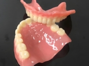 全口吸附性義齒同普通活動義齒有咩區別？維港口腔吸附性義齒幾錢？