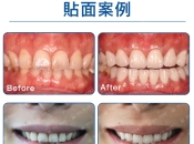 牙貼片 vs 全瓷牙點揀好？深圳維港口腔專業分析+最新優惠！