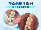 蛀牙補牙之後仲有幾率會蛀牙，咁仲有必要補牙嗎？維港口腔補牙最新優惠資訊