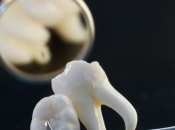 福田剝智慧齒牙科排名2026？剝智慧齒後幾時可以刷牙？