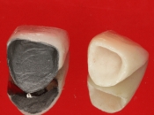 影響烤瓷牙質量嘅因素,大陸烤瓷牙質量如何？收費點樣？