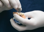 植牙點解要滿18歲？維港口腔好唔好？