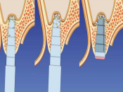 深圳維港口腔植牙——上頜竇提升術後注意事項
