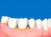 維港口腔專家解釋如何有效預防牙周炎?