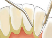 珠海舒適潔牙和噴砂潔牙的區別是什麼？