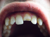 深圳牙醫解答：牙齒甩咗一半仲能夠修復嗎