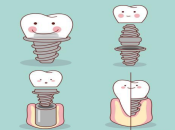 植體骨結合能力唔好對種植牙有咩影響咧？深圳植牙要幾錢？
