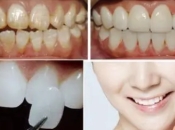 深圳牙齒美白——有牙周病還可以進行美學修復嗎？