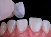 福田牙貼片可以用幾多年？福田牙貼有冇優惠？