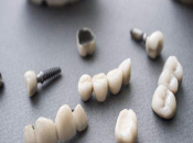 深圳維港口腔植牙專家解答：種植牙需要點樣保養？