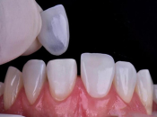 深圳維港牙醫解答：刷牙越用力牙齒越白越乾淨？真正嘅牙齒美白方法係哩啲！